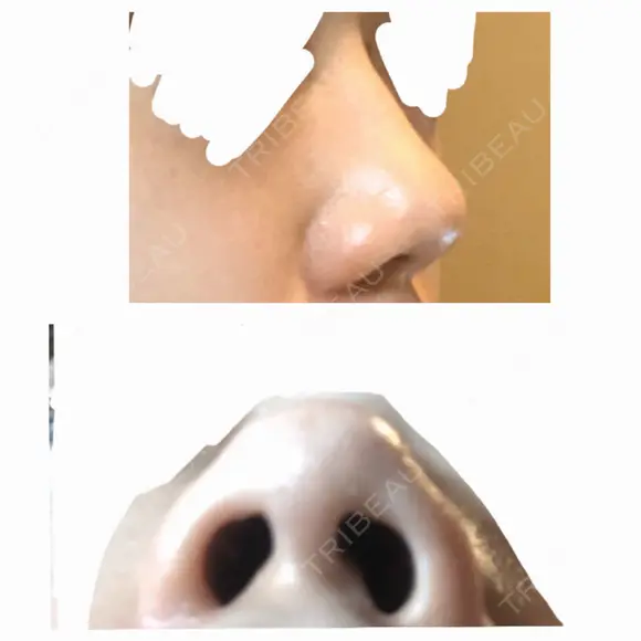 鼻尖縮小 東京ヒルズクリニック 新宿院 BEFORE メイン用