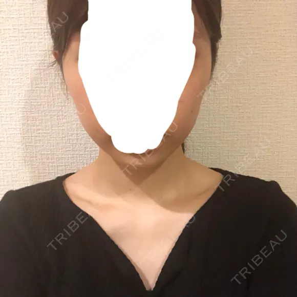 ボトックス（エラ・小顔） 東京ヒルズクリニック 新宿院 BEFORE メイン用