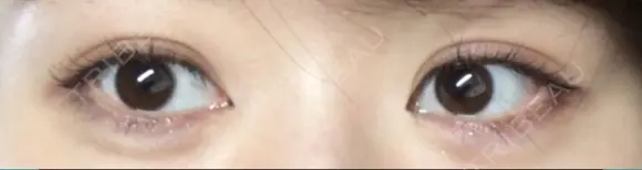 目尻切開 / タレ目形成・グラマラスライン（切開） / 目尻靭帯移動 / その他（目元） FROM B整形外科 (旧バウム整形外科) BEFORE メイン用