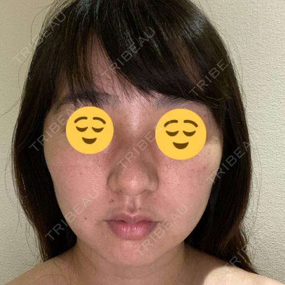 毛穴洗浄（ハイドラフェイシャルなど） 自由が丘クリニック BEFORE メイン用