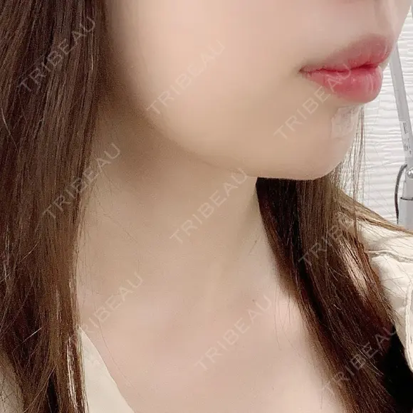 脂肪溶解注射（顔） TCB東京中央美容外科 中野院 BEFORE メイン用