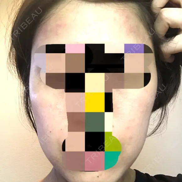 ピーリング（ニキビ・毛穴） 自由が丘クリニック BEFORE メイン用