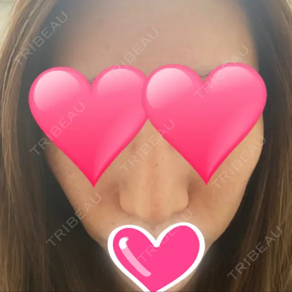 鼻中隔延長（切開） / 骨切幅寄せ / ワシ鼻修正・ハンプ切除 表参道スキンクリニック 表参道院 BEFORE メイン用