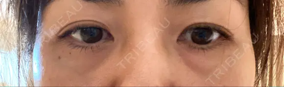 クマ治療 / 下まぶたたるみ取り / 下まぶたの脂肪取り TCB東京中央美容外科 中野院 BEFORE メイン用