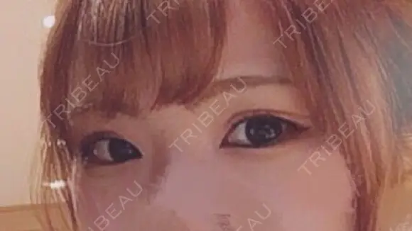 二重切開 / 目頭切開 / 眼瞼下垂（切開） / 目尻切開 / 上まぶたたるみ取り / ヒアルロン酸注入（涙袋） ジュエリー美容外科 BEFORE メイン用