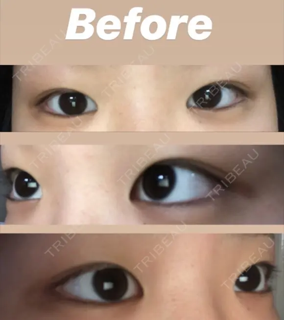 二重埋没 TCB東京中央美容外科 仙台駅前院 BEFORE メイン用