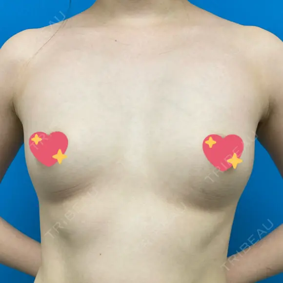 脂肪吸引（脚） / 豊胸（脂肪注入） 南クリニック BEFORE メイン用