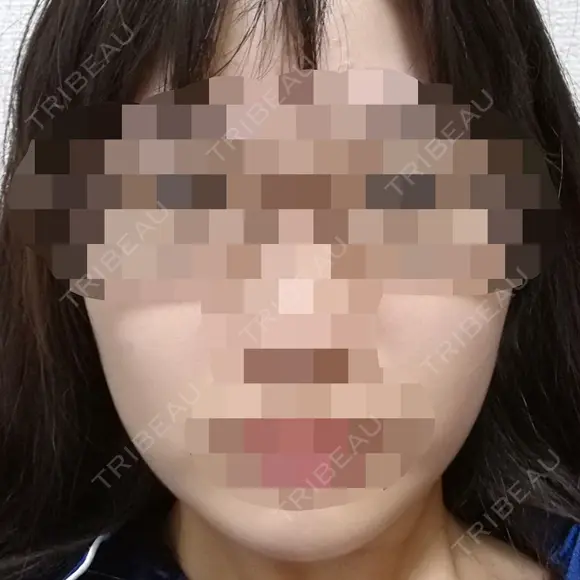 ボトックス（エラ・小顔） 湘南美容クリニック 静岡院 BEFORE メイン用