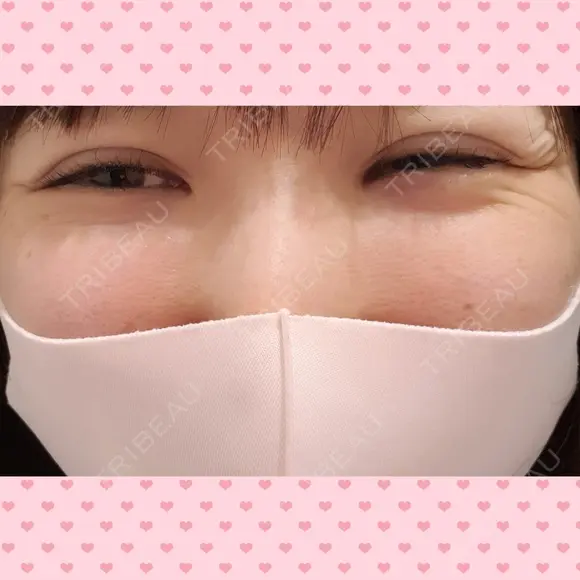 シワ取りボトックス 湘南美容クリニック 仙台院 BEFORE メイン用