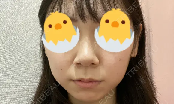 鼻尖形成（切開） / 小鼻縮小（切開） / ヒアルロン酸注入（あご） / ボトックス（エラ・小顔） / ヒアルロン酸注入（唇） / 毛穴洗浄（ハイドラフェイシャルなど） / その他（鼻） TCB東京中央美容外科 横浜院 BEFORE メイン用