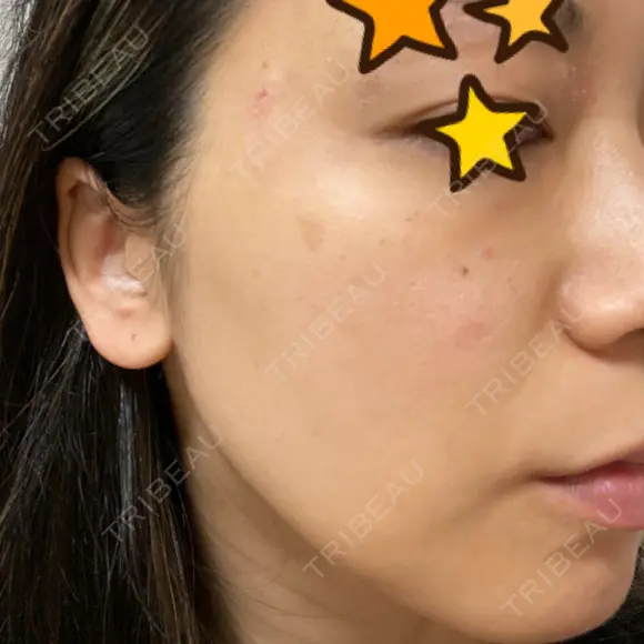 ピーリング（ニキビ・毛穴） / 美肌レーザー / フラクショナルレーザー（毛穴・ニキビ跡） PICO BEAUTY CLINIC BEFORE メイン用