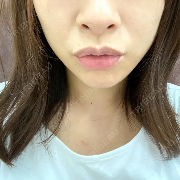 アートメイク（唇） BMC CLINIC 南青山 BEFORE メイン用