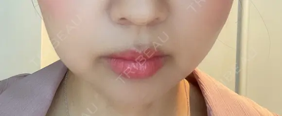 脂肪溶解注射（顔） 赤坂プレミアクリニック BEFORE メイン用