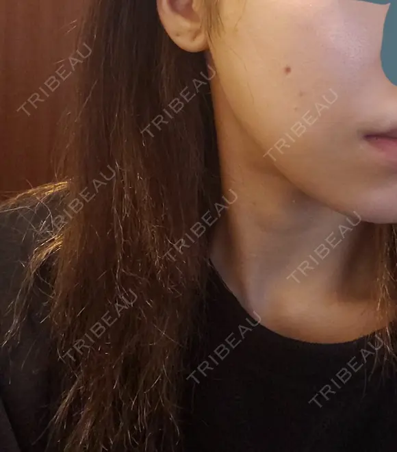 ニキビ治療 品川美容外科 仙台院 BEFORE メイン用