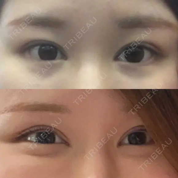 目頭切開 / 蒙古ひだ形成 / 目元修正 イブ整形外科 BEFORE メイン用