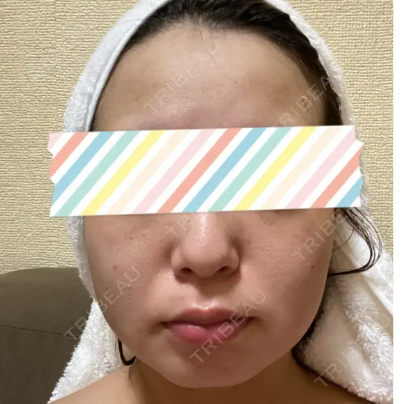 脂肪吸引（顔） 表参道スキンクリニック 表参道院 BEFORE メイン用