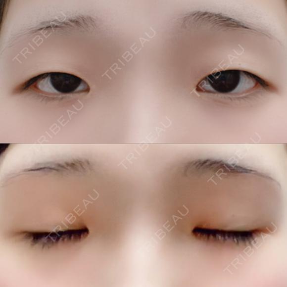 二重埋没 湘南美容クリニック 赤坂見附院 BEFORE メイン用