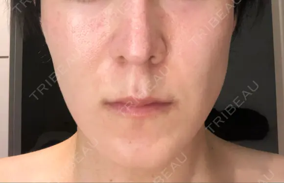 骨切り（あご） / 骨削り（エラ） 加藤クリニック 麻布東京院 BEFORE メイン用