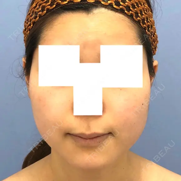 糸リフト / バッカルファット除去 / 脂肪吸引（顔） / ボトックス（エラ・小顔） 湘南美容クリニック 秋葉原院 BEFORE メイン用