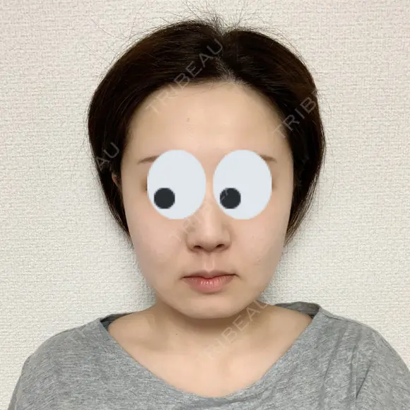 切開リフト 石倉クリニック 水戸院 BEFORE メイン用