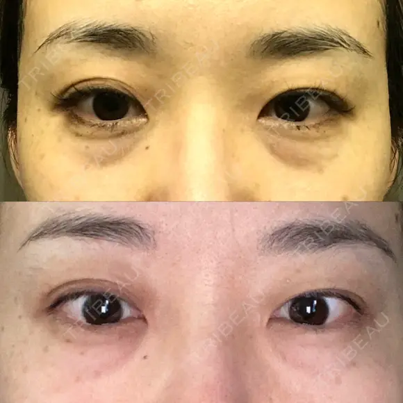 クマ治療 / 下まぶたの脂肪取り TCB東京中央美容外科 中野院 BEFORE メイン用