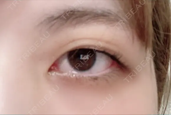 二重埋没 湘南美容クリニック 藤沢院 BEFORE メイン用