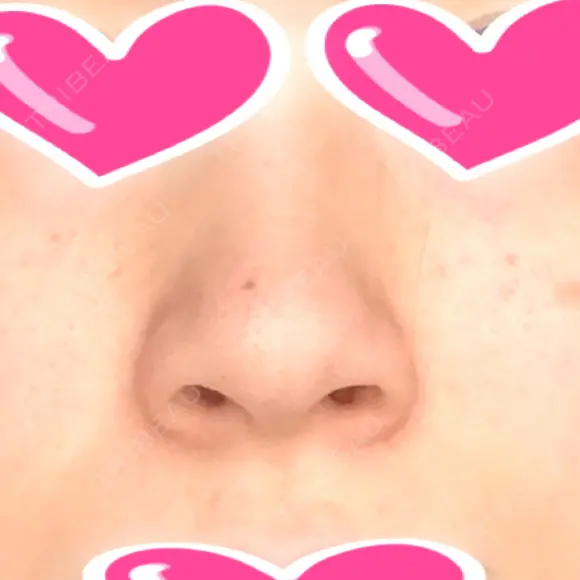 鼻尖形成（切開） / 小鼻縮小（切開） / 軟骨移植 湘南美容クリニック 船橋院 BEFORE メイン用