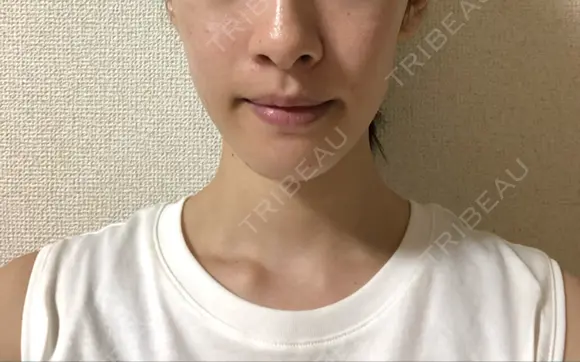 脂肪溶解注射（顔） 銀座フェイスクリニック（小顔整形・輪郭整形專門） BEFORE メイン用