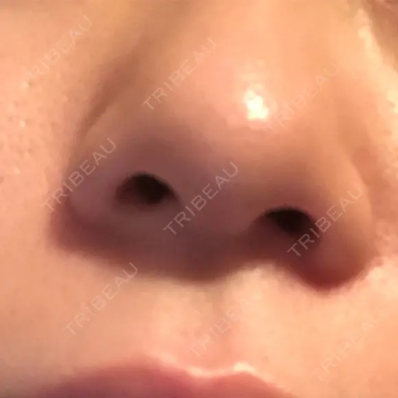 鼻尖形成（切開） / 軟骨移植 白山クリニック 大分 BEFORE メイン用