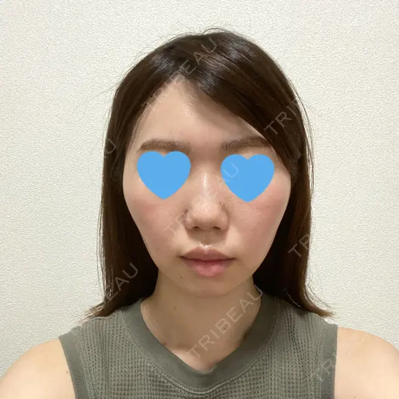 脂肪溶解注射（顔） 赤坂プレミアクリニック BEFORE メイン用