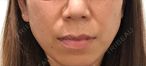 人中短縮 銀座アテナクリニック BEFORE メイン用