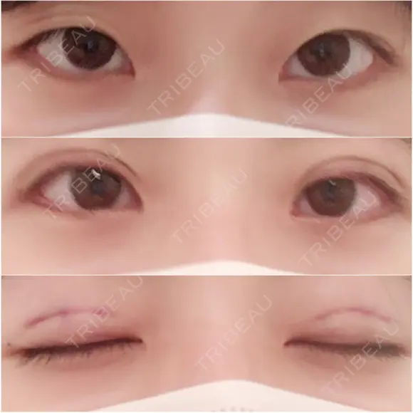 二重埋没 植村美容外科 BEFORE メイン用