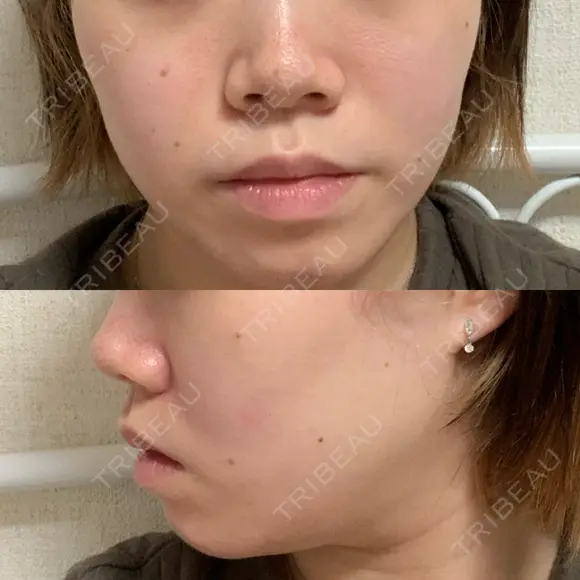 ボトックス（エラ・小顔） 湘南美容クリニック 川崎院 BEFORE メイン用