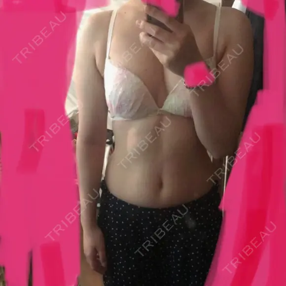 脂肪吸引（二の腕） 湘南美容クリニック 八王子院 BEFORE メイン用