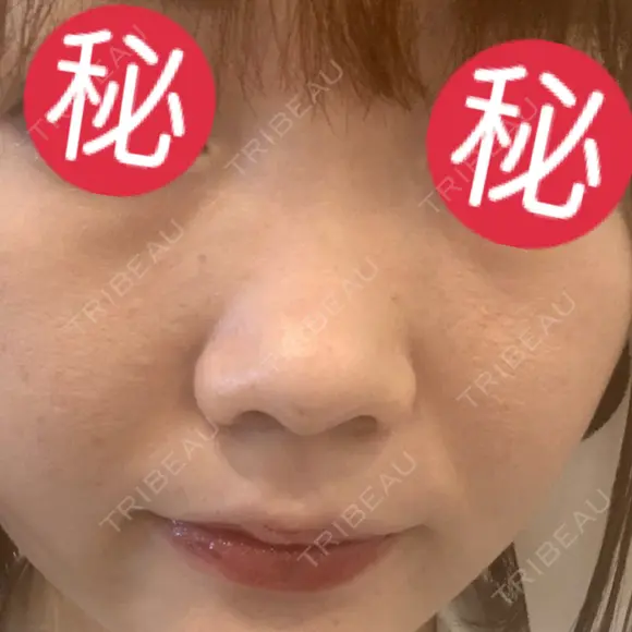 小鼻縮小（切開） / ヒアルロン酸注入（鼻） 東京形成美容外科 船橋院 BEFORE メイン用