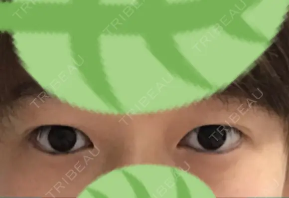 二重埋没 / 自然癒着法 表参道スキンクリニック 名古屋院（DAILY SKIN CLINIC提携院） BEFORE メイン用