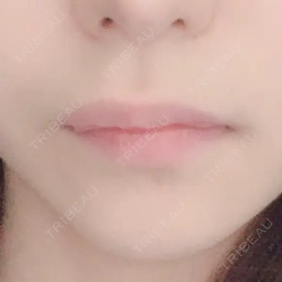人中短縮 / 口角挙上 / その他（口元） 清潭女神美容外科 BEFORE メイン用