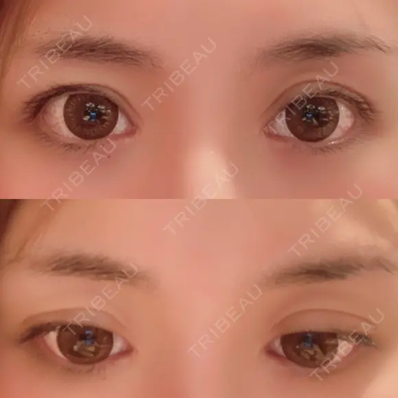 二重切開 / 眼瞼下垂（切開） / 目元修正 シエルクリニック BEFORE メイン用