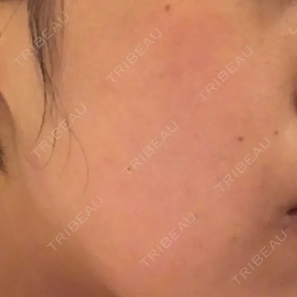 ピーリング（ニキビ・毛穴） 自由が丘クリニック BEFORE メイン用