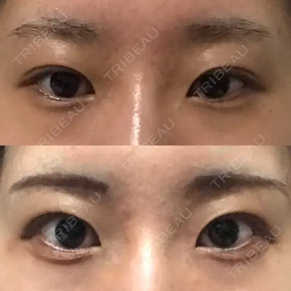 目尻切開 / タレ目形成・グラマラスライン（切開） A CLINIC（エークリニック） 銀座院 BEFORE メイン用