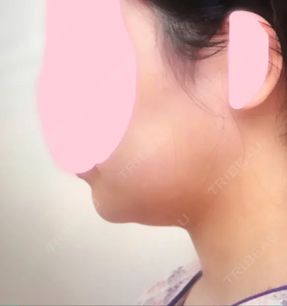 糸リフト / 脂肪吸引（顔） / その他（輪郭） / 切開リフト 清潭清楚整形外科 BEFORE メイン用