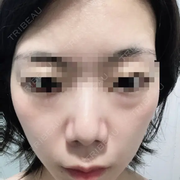 ハイフ（顔） 共立美容外科 仙台院 BEFORE メイン用