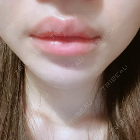 口唇縮小術 くさのたろうクリニック BEFORE メイン用