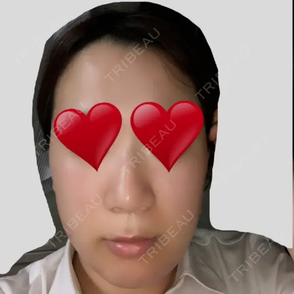 骨切り（あご） / 骨削り（エラ） リラ・クラニオフェイシャル・クリニック BEFORE メイン用