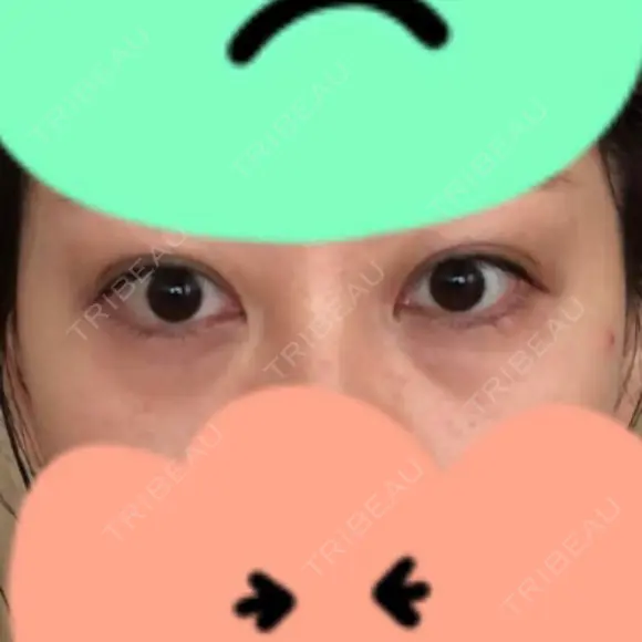 クマ治療 湘南美容クリニック 千葉センシティ院 BEFORE メイン用
