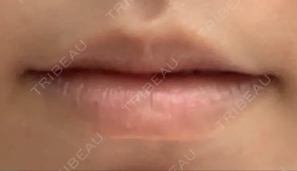 アートメイク（唇） LETICIA CLINIC（レティシア クリニック） BEFORE メイン用