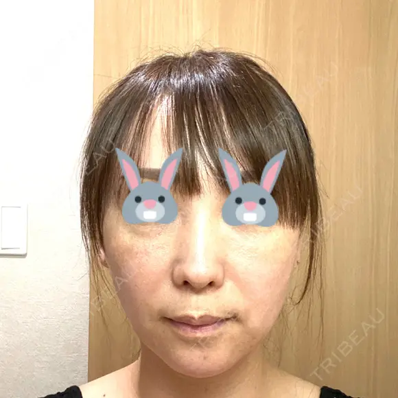 切開リフト 石倉クリニック 水戸院 BEFORE メイン用