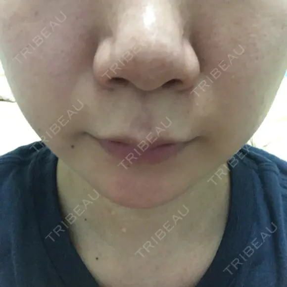 鼻尖形成（切開） / ヒアルロン酸注入（鼻） 東京ヒルズクリニック 新宿院 BEFORE メイン用