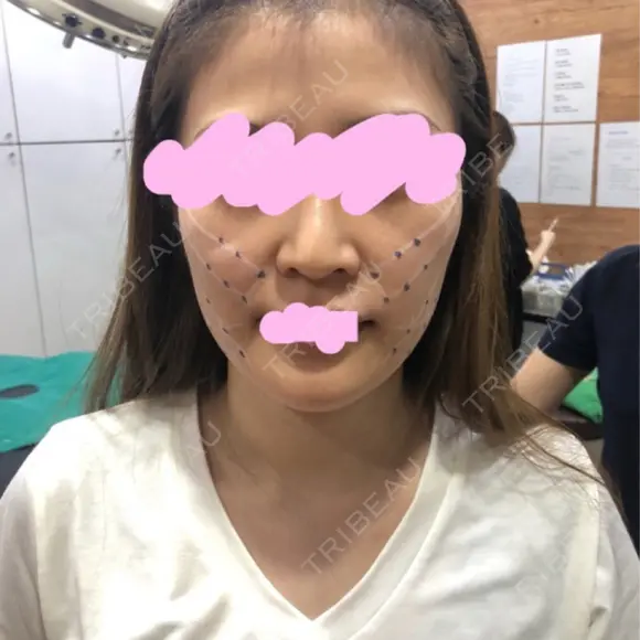 スレッドノーズ / その他（肌） キップン整形外科 BEFORE メイン用