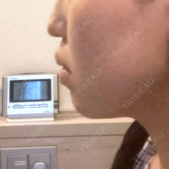 バッカルファット除去 / セットバック 銀座フェイスクリニック（小顔整形・輪郭整形專門） BEFORE メイン用